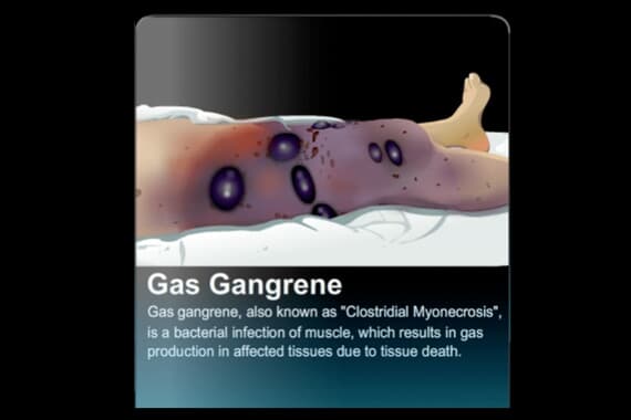 Gas Gangrene