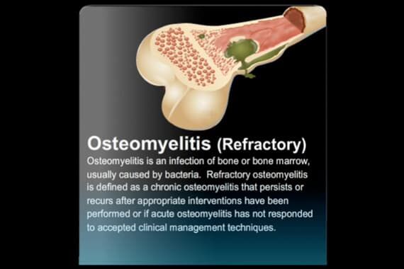 Osteomyelitis Refractory